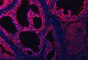Immunofluorescent staining of FFPE human intestinal cancer tissue with PSMB4 antibody (red) and DAPI nuclear stain (blue). HIER: steam section in pH8 EDTA buffer for 20 min.