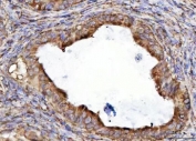 IHC staining of FFPE human ovarian cancer tissue with RPL36 antibody. HIER: boil tissue sections in pH8 EDTA for 20 min and allow to cool before testing.