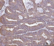 IHC staining of FFPE human endometrial adenocarcinoma tissue with RPL36 antibody. HIER: boil tissue sections in pH8 EDTA for 20 min and allow to cool before testing.
