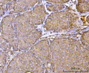 IHC staining of FFPE human breast cancer tissue with RPL36 antibody. HIER: boil tissue sections in pH8 EDTA for 20 min and allow to cool before testing.