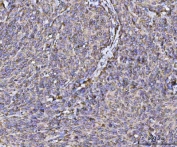 IHC staining of FFPE human cervical cancer tissue with RPL36 antibody. HIER: boil tissue sections in pH8 EDTA for 20 min and allow to cool before testing.