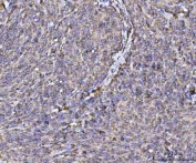 IHC staining of FFPE human cervical cancer tissue with RPL36 antibody. HIER: boil tissue sections in pH8 EDTA for 20 min and allow to cool before testing.