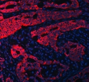 Immunofluorescent staining of FFPE human colon cancer tissue with RPL36 antibody (red) and DAPI nuclear stain (blue). HIER: steam section in pH8 EDTA buffer for 20 min.