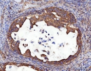 IHC staining of FFPE human ovarian cancer tissue with RRS1 antibody. HIER: boil tissue sections in pH8 EDTA for 20 min and allow to cool before testing.