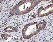 IHC staining of FFPE human colorectal adenocarcinoma tissue with RRS1 antibody. HIER: boil tissue sections in pH8 EDTA for 20 min and allow to cool before testing.