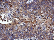 IHC staining of FFPE human esophageal squamous carcinoma tissue with RRS1 antibody. HIER: boil tissue sections in pH8 EDTA for 20 min and allow to cool before testing.