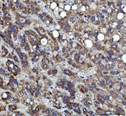 IHC staining of FFPE human liver cancer tissue with RRS1 antibody. HIER: boil tissue sections in pH8 EDTA for 20 min and allow to cool before testing.