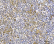 IHC staining of FFPE human cervical cancer tissue with RRS1 antibody. HIER: boil tissue sections in pH8 EDTA for 20 min and allow to cool before testing.
