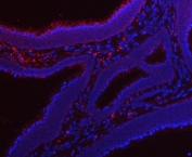Immunofluorescent staining of FFPE human colon cancer tissue with RRS1 antibody (red) and DAPI nuclear stain (blue). HIER: steam section in pH6 citrate buffer for 20 min.