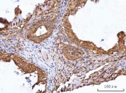 IHC staining of FFPE human ovarian cancer tissue with TIP49A antibody. HIER: boil tissue sections in pH8 EDTA for 20 min and allow to cool before testing.