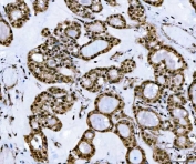 IHC staining of FFPE human thyroid cancer tissue with TIP49A antibody. HIER: boil tissue sections in pH8 EDTA for 20 min and allow to cool before testing.