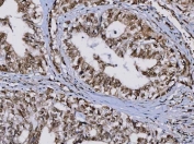 IHC staining of FFPE human lung adenocarcinoma tissue with TIP49A antibody. HIER: boil tissue sections in pH8 EDTA for 20 min and allow to cool before testing.