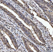 IHC staining of FFPE human colorectal adenocarcinoma tissue with TIP49A antibody. HIER: boil tissue sections in pH8 EDTA for 20 min and allow to cool before testing.