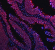 Immunofluorescent staining of FFPE human colon cancer tissue with TIP49A antibody (red) and DAPI nuclear stain (blue). HIER: steam section in pH8 EDTA buffer for 20 min.