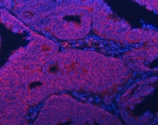 Immunofluorescent staining of FFPE human endometrial cancer tissue with Septin 2 antibody (red) and DAPI nuclear stain (blue). HIER: steam section in pH8 EDTA buffer for 20 min.