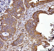 IHC staining of FFPE human colorectal adenocarcinoma tissue with Septin 2 antibody. HIER: boil tissue sections in pH8 EDTA for 20 min and allow to cool before testing.