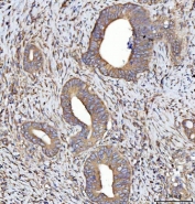 IHC staining of FFPE human colorectal adenocarcinoma tissue with SEPT7 antibody. HIER: boil tissue sections in pH8 EDTA for 20 min and allow to cool before testing.