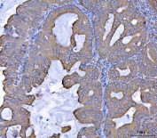 IHC staining of FFPE human ovarian cancer tissue with SEPT7 antibody. HIER: boil tissue sections in pH8 EDTA for 20 min and allow to cool before testing.