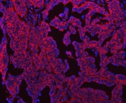 Immunofluorescent staining of FFPE human ovarian cancer tissue with SEPT7 antibody (red) and DAPI nuclear stain (blue). HIER: steam section in pH6 citrate buffer for 20 min.