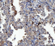 IHC staining of FFPE human lung cancer tissue with SEPT9 antibody. HIER: boil tissue sections in pH8 EDTA for 20 min and allow to cool before testing.