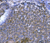 IHC staining of FFPE human breast cancer tissue with SEPT9 antibody. HIER: boil tissue sections in pH8 EDTA for 20 min and allow to cool before testing.