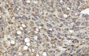 IHC staining of FFPE human liver cancer tissue with SEPT9 antibody. HIER: boil tissue sections in pH8 EDTA for 20 min and allow to cool before testing.