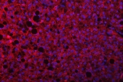 Immunofluorescent staining of FFPE human liver cancer tissue with SEPT9 antibody (red) and DAPI nuclear stain (blue). HIER: steam section in pH8 EDTA buffer for 20 min.