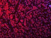 Immunofluorescent staining of FFPE human breast cancer tissue with SEPT9 antibody (red) and DAPI nuclear stain (blue). HIER: steam section in pH8 EDTA buffer for 20 min.