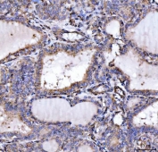 IHC staining of FFPE human thyroid cancer tissue with SLU7 antibody. HIER: boil tissue sections in pH8 EDTA for 20 min and allow to cool before testing.