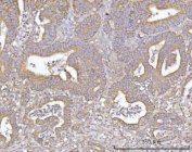 IHC staining of FFPE human colorectal adenocarcinoma tissue with SLU7 antibody. HIER: boil tissue sections in pH8 EDTA for 20 min and allow to cool before testing.