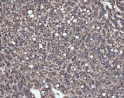 IHC staining of FFPE human liver cancer tissue with SLU7 antibody. HIER: boil tissue sections in pH8 EDTA for 20 min and allow to cool before testing.