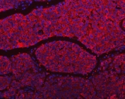 Immunofluorescent staining of FFPE human liver cancer tissue with SLU7 antibody (red) and DAPI nuclear stain (blue). HIER: steam section in pH6 citrate buffer for 20 min.