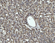 IHC staining of FFPE human liver cancer tissue with TIP3 antibody. HIER: boil tissue sections in pH8 EDTA for 20 min and allow to cool before testing.