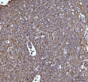 IHC staining of FFPE human esophageal squamous carcinoma tissue with TIP3 antibody. HIER: boil tissue sections in pH8 EDTA for 20 min and allow to cool before testing.
