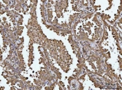 IHC staining of FFPE human lung cancer tissue with TIP3 antibody. HIER: boil tissue sections in pH8 EDTA for 20 min and allow to cool before testing.