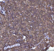 IHC staining of FFPE human cervical cancer tissue with TIP3 antibody. HIER: boil tissue sections in pH8 EDTA for 20 min and allow to cool before testing.