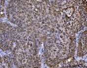 IHC staining of FFPE human lung cancer tissue with TARBP2 antibody. HIER: boil tissue sections in pH8 EDTA for 20 min and allow to cool before testing.
