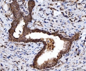 IHC staining of FFPE human prostate cancer tissue with TARBP2 antibody. HIER: boil tissue sections in pH8 EDTA for 20 min and allow to cool before testing.