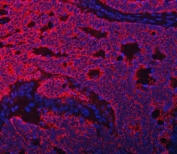 Immunofluorescent staining of FFPE human intestinal cancer tissue with Transcription factor EB antibody (red) and DAPI nuclear stain (blue). HIER: steam section in pH8 EDTA buffer for 20 min.