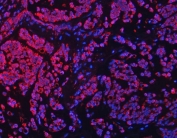 Immunofluorescent staining of FFPE human breast cancer tissue with Transcription factor EB antibody (red) and DAPI nuclear stain (blue). HIER: steam section in pH8 EDTA buffer for 20 min.