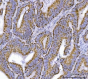 IHC staining of FFPE human colorectal adenocarcinoma tissue with Transcription factor EB antibody. HIER: boil tissue sections in pH8 EDTA for 20 min and allow to cool before testing.