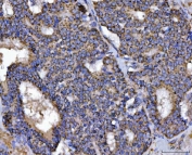 IHC staining of FFPE human breast cancer tissue with Transcription factor EB antibody. HIER: boil tissue sections in pH8 EDTA for 20 min and allow to cool before testing.