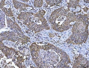 IHC staining of FFPE human lung squamous cell carcinoma tissue with Transcription factor EB antibody. HIER: boil tissue sections in pH8 EDTA for 20 min and allow to cool before testing.