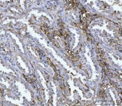 IHC staining of FFPE human lung cancer tissue with VIPR2 antibody. HIER: boil tissue sections in pH8 EDTA for 20 min and allow to cool before testing.