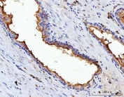 IHC staining of FFPE human prostate cancer tissue with VIPR2 antibody. HIER: boil tissue sections in pH8 EDTA for 20 min and allow to cool before testing.