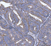 IHC staining of FFPE human endometrial adenocarcinoma tissue with CANX antibody. HIER: boil tissue sections in pH8 EDTA for 20 min and allow to cool before testing.