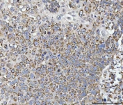 IHC staining of FFPE human lung cancer tissue with CANX antibody. HIER: boil tissue sections in pH8 EDTA for 20 min and allow to cool before testing.