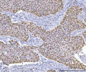 IHC staining of FFPE human esophageal squamous carcinoma tissue with TP53 antibody. HIER: boil tissue sections in pH8 EDTA for 20 min and allow to cool before testing.