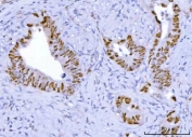 IHC staining of FFPE human colorectal adenocarcinoma tissue with TP53 antibody. HIER: boil tissue sections in pH8 EDTA for 20 min and allow to cool before testing.