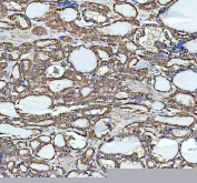 IHC staining of FFPE human thyroid cancer tissue with MARS1 antibody, HRP-labeled secondary and DAB substrate. HIER: boil tissue sections in pH8 EDTA for 20 min and allow to cool before testing.